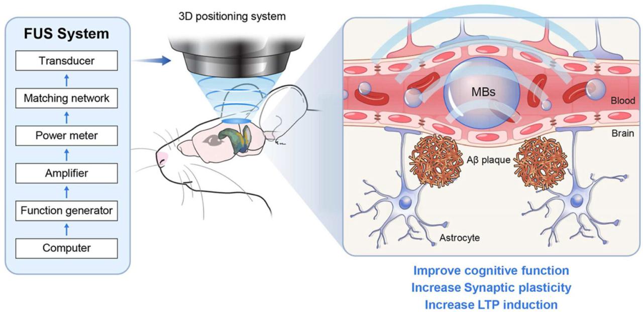 Barrera hematoencefalica alzheimer ultrasonido